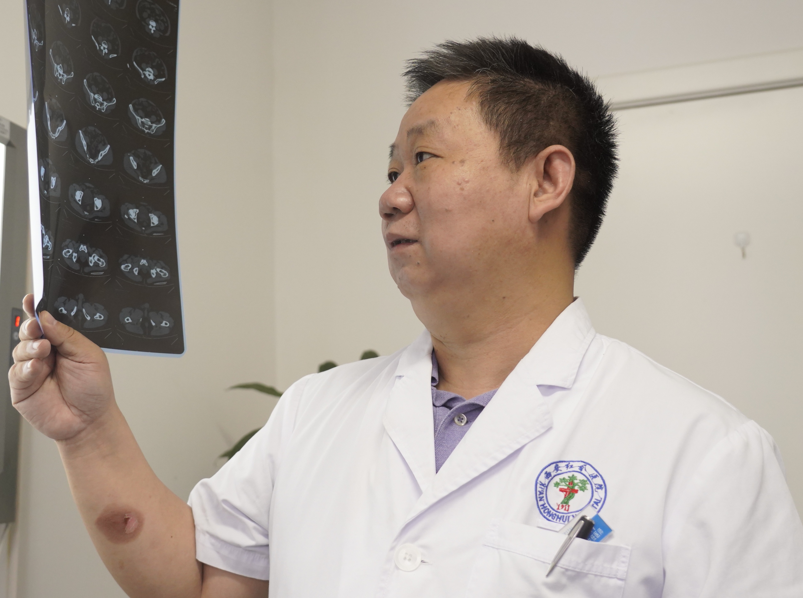 西安市红会医院泌尿外科,陕西红会医院泌尿科