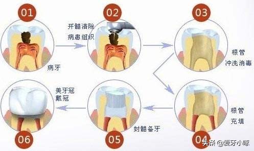 小洞不补大洞受苦早发现早治疗,为什么说牙齿小洞不补大洞吃苦