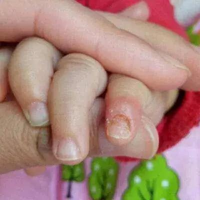 科普|宝宝指甲凹凸不平怎么办，营养补给和卫生习惯能解决！