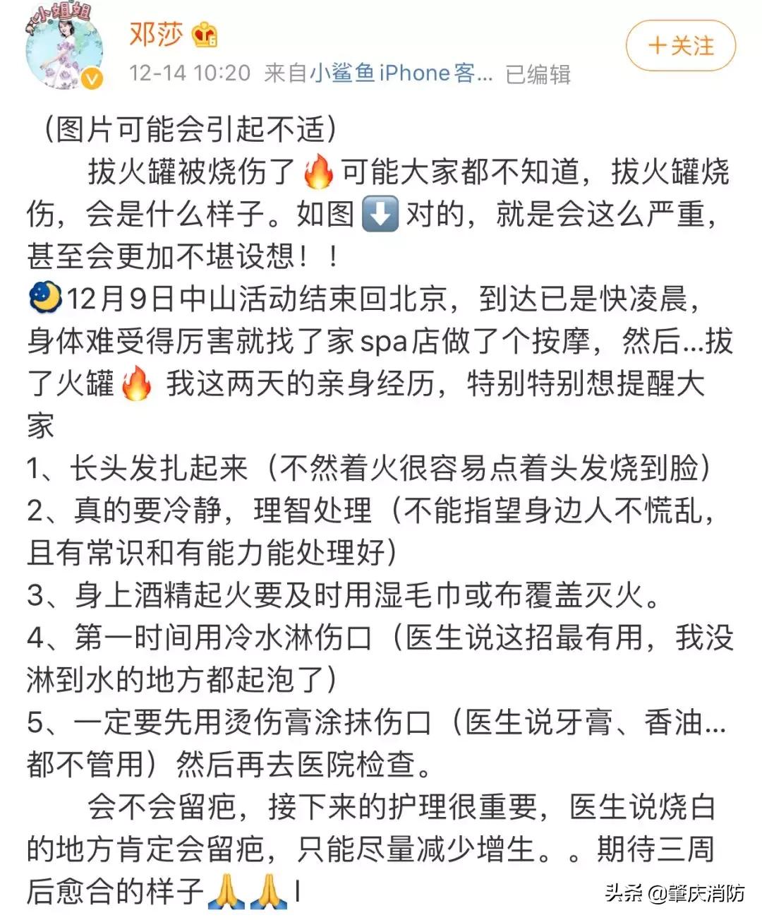 女子拔火罐被烧伤后续,明星拔火罐烧伤事件