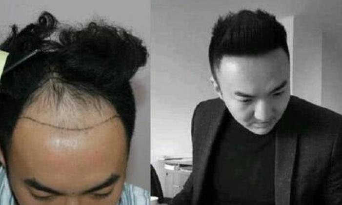 脂溢性脱发有植发的必要吗,脂溢性脱发植发靠谱吗真的有效吗