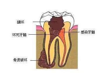 五岁小孩牙齿蛀了需要补吗,门牙边上的牙齿蛀了能补吗