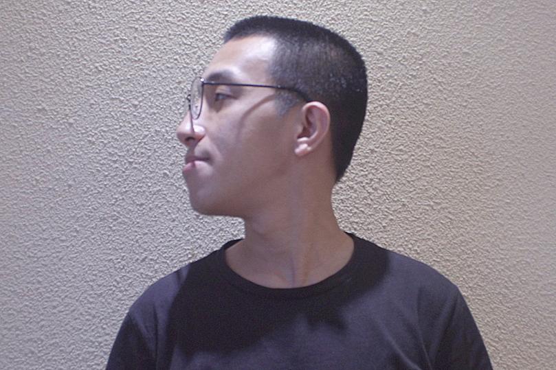 严重骨性地包天正畸效果,地包天矫正后又反颌怎么办