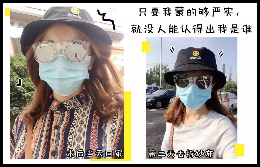 割双眼皮术前术后对比图,割双眼皮术前需要注意事项