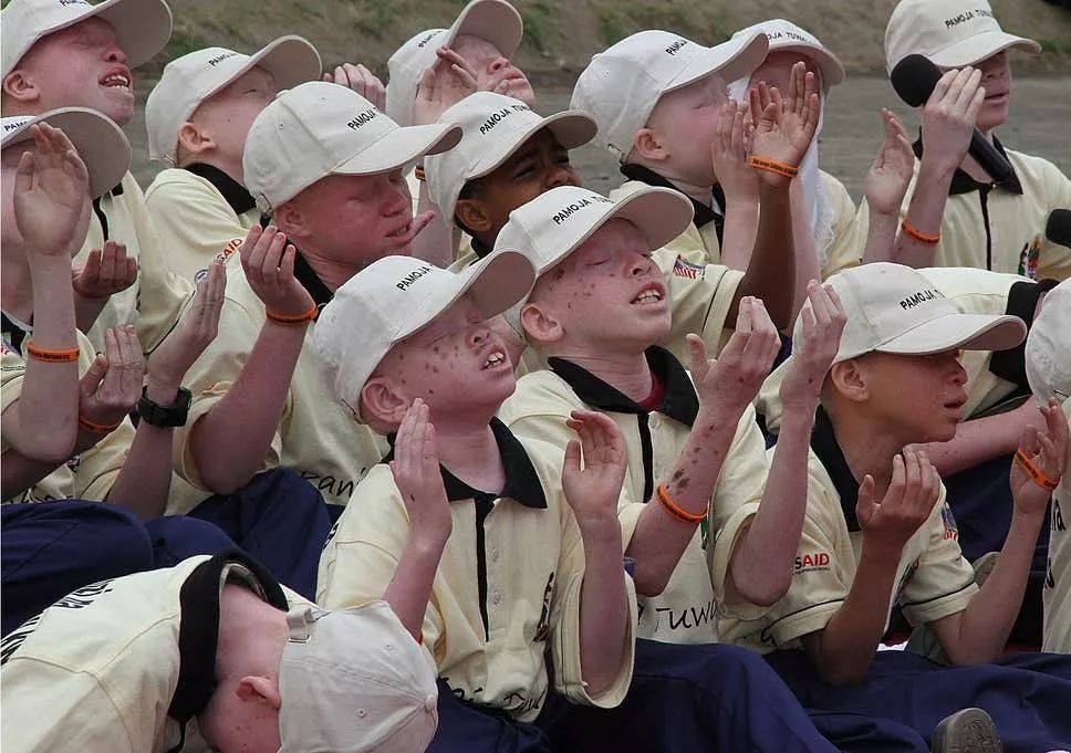 患上白化病不能使黑人免受歧视，他们沦为了同族人的”猎物“