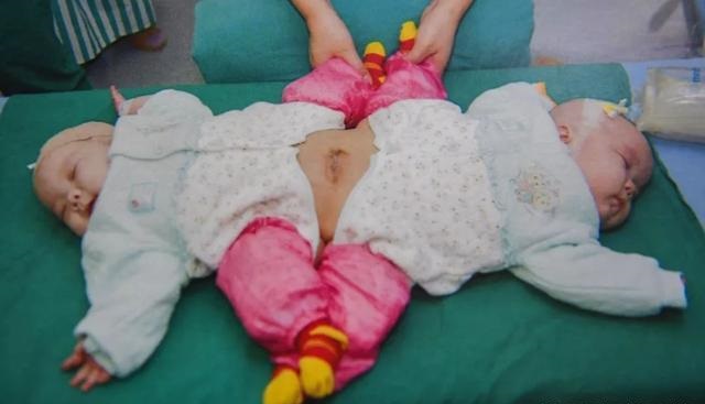 连体双胞胎坐骨连在一起,首例坐骨连体分离11年