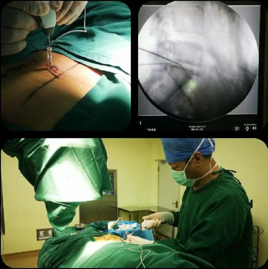 腰椎间盘突出压迫马尾能治好么,腰间盘突出压迫马尾神经怎么治愈