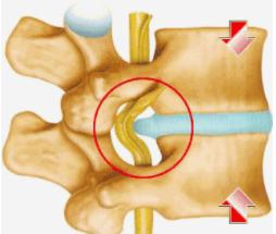 腰椎间盘突出腰腿痛平时锻炼方法,腰椎间盘突出脚麻疼痛怎么缓解