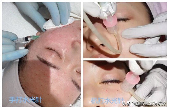 水光针和光子嫩肤亲身体验,水光针真的可以让皮肤变好吗