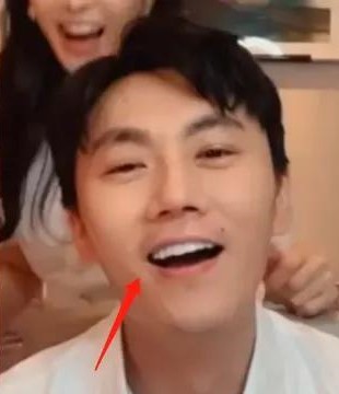 吴宣仪烤瓷牙怎么做,吴宣仪的整牙前