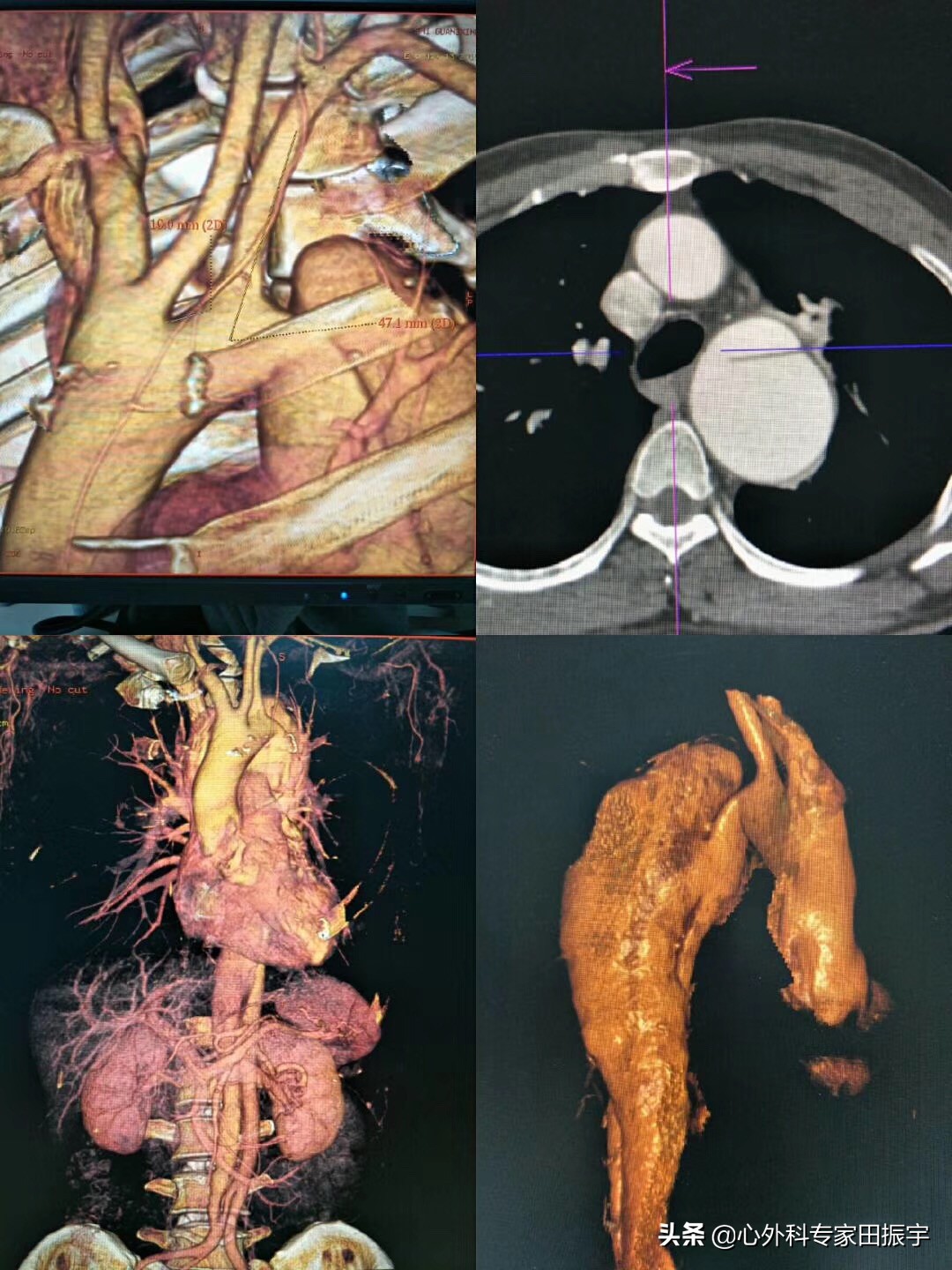 胸主动脉瘤最常见的护理措施,胸主动脉疾病