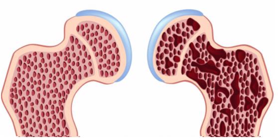 血钙含量和骨质疏松有关吗?