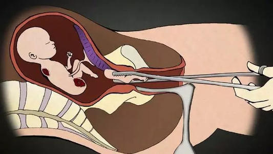 医生：劝君不要把人流当儿戏