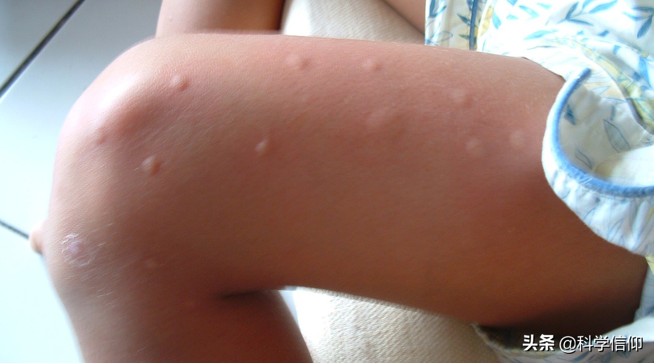 蚊子为什么会对你血不释口,爱招蚊子真跟血型有关吗