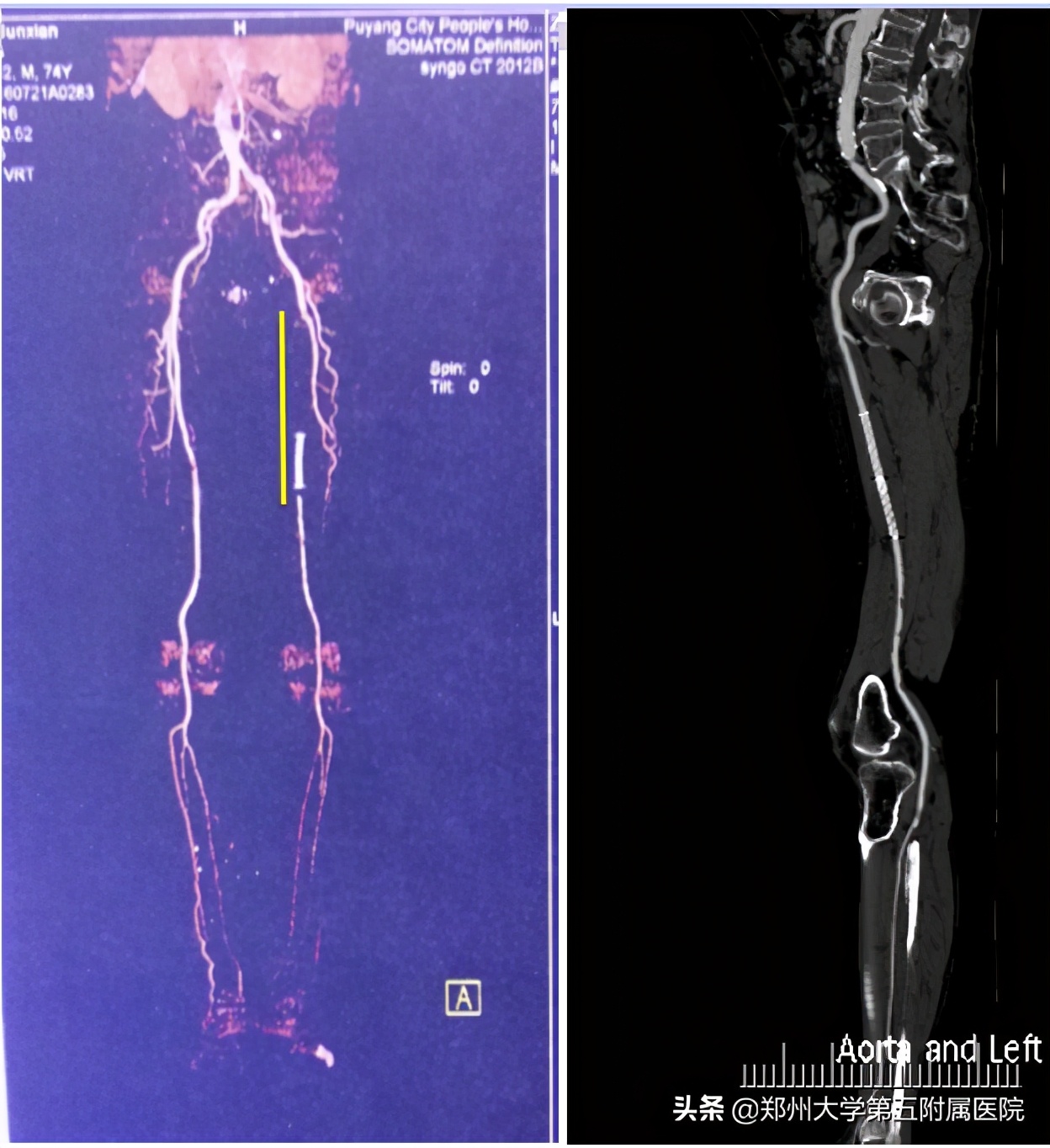 腿上放支架的风险和副作用,腿上放了钢板拿出来有后遗症吗