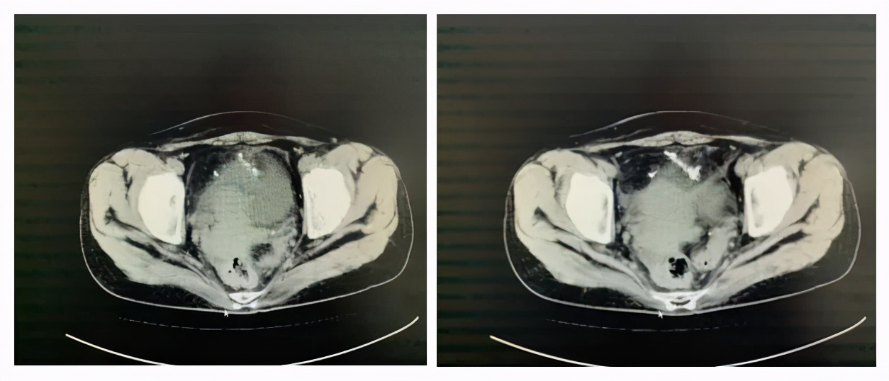 太原市第七人民医院再开新技术「双镜联合切除盆腔异物」