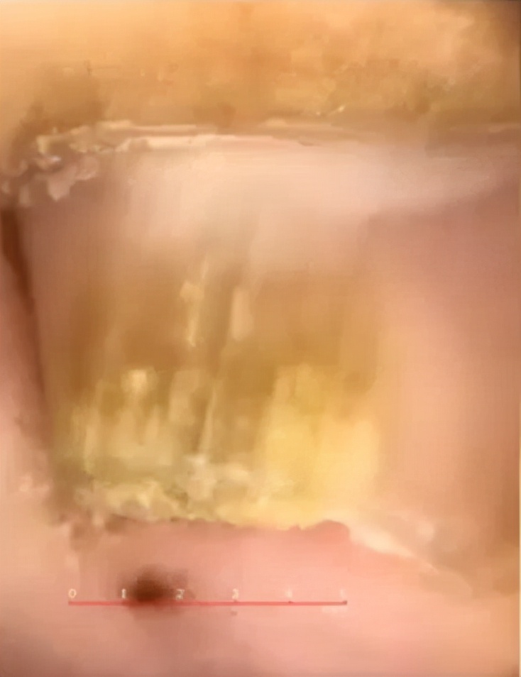 治灰指甲要验血吗,医院检查灰指甲挂号什么科