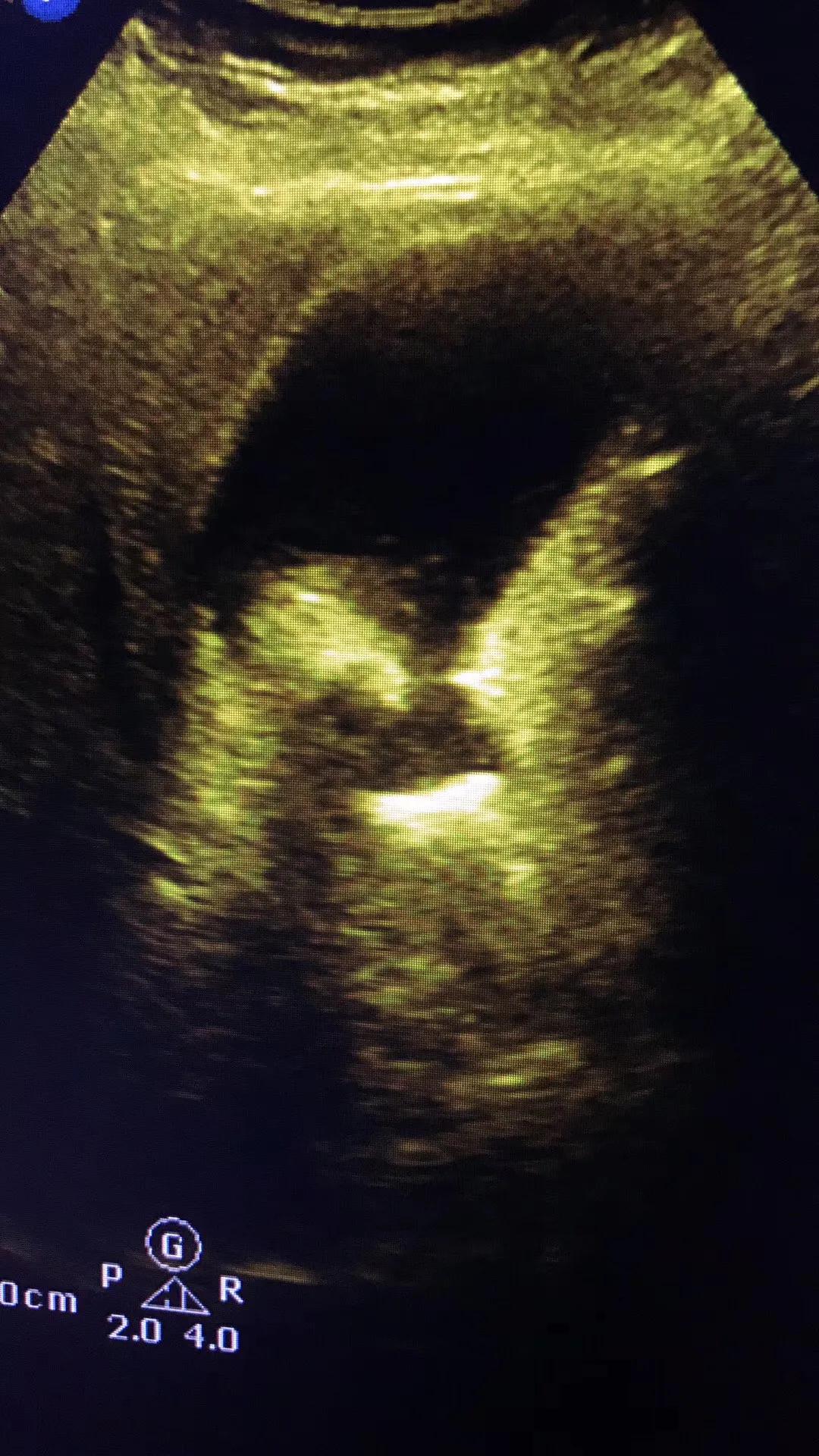 一公分胆结石并且引发急性胆囊炎,一颗胆结石必须摘胆吗