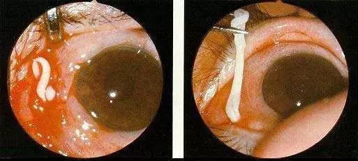 28岁小伙癫痫16年，脑子被虫吃了！竟是爸爸给他吃这个珍稀“大补”！