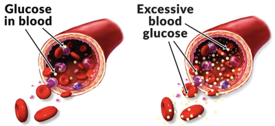 杨天真糖尿病打针,杨天真为何得糖尿病