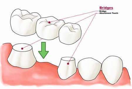 单颗牙缺失的修复方法,单颗牙缺失最好办法