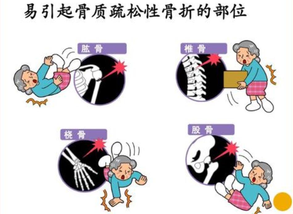 老人屁股到左腿疼一般什么原因,老人屁股的骨头痛到底是什么原因