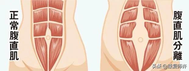 产后腹直肌分离的解决方法,产后腹直肌分离怎么处理