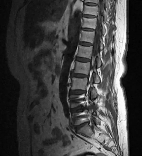 有节育环能否做胸腔核磁共振,有节育环能否做膝盖核磁共振