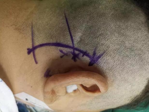 说话诱发三叉神经痛,耳后根三叉神经痛一招自愈