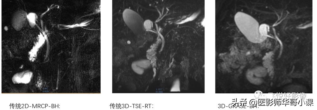 「飞利浦磁共振技术」胆道系统胆胰管水成像之3D_MRCP_BH