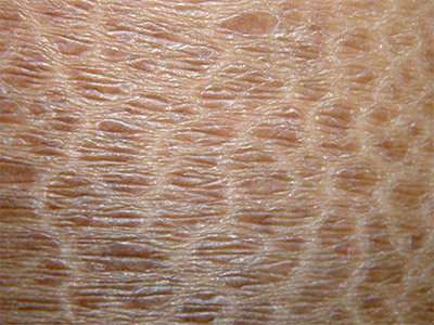 鱼鳞病有哪些治疗的方法,鱼鳞病的病因及症状