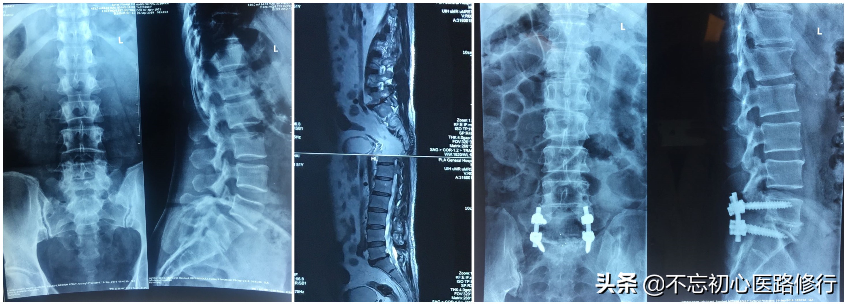 治疗腰椎间盘突出的方法与思路,腰椎间盘突出腰腿酸痛多久能好