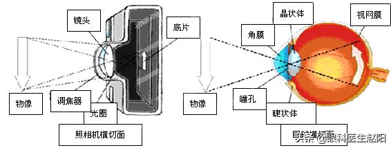 白内障引起后发障怎么办,白内障跟胬肉可以一次解决吗