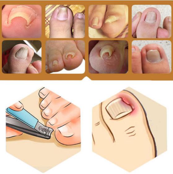脚趾甲总往肉里长怎么矫正,嵌甲旁边的肉怎么消除