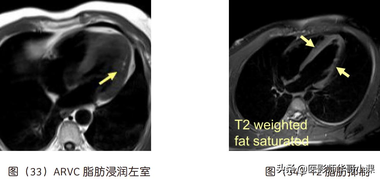 磁共振心脏扫描标准切面,心脏mri扫描定位