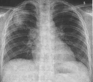 除了肺结核其他结核传不传染,颈部结核病会传染吗