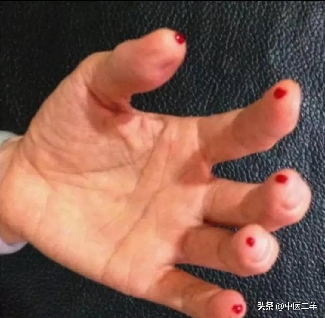 潘粤明父亲中风,潘粤明父亲突发脑溢血