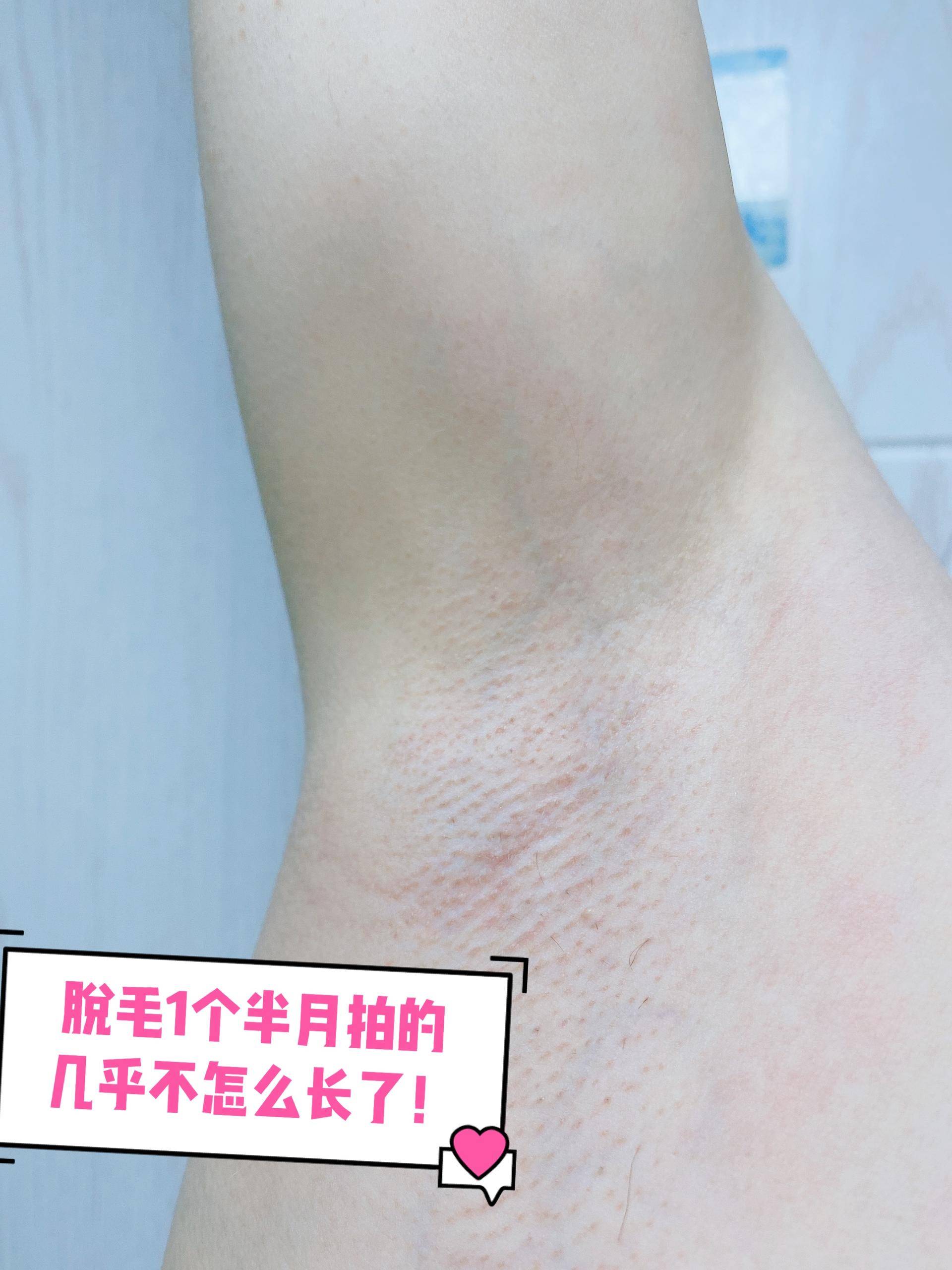 吐槽脱毛仪脱毛发炎,吐槽ellkii脱毛仪