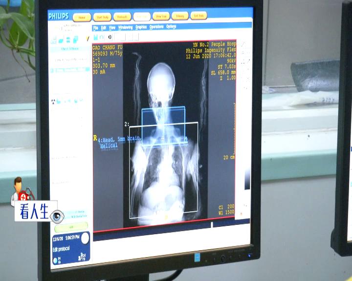 脑梗与癫痫哪都有,突发脑梗哪种情况不能溶栓治疗