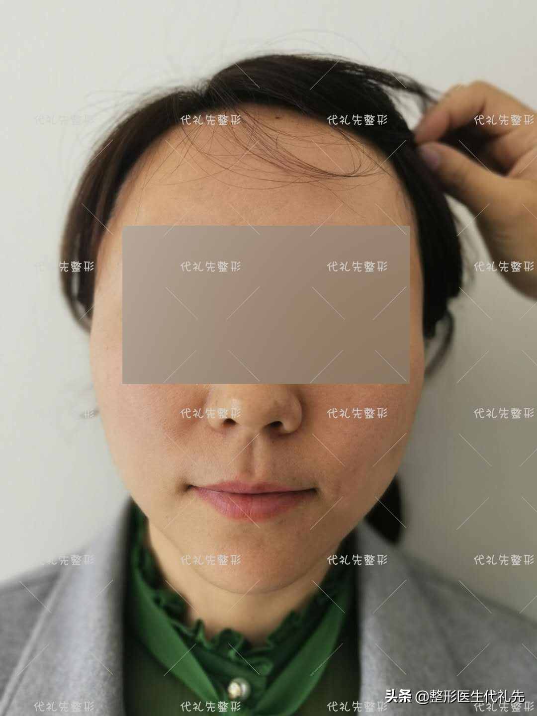 口角囊袋是整形后遗症么,去除口角囊袋恢复过程