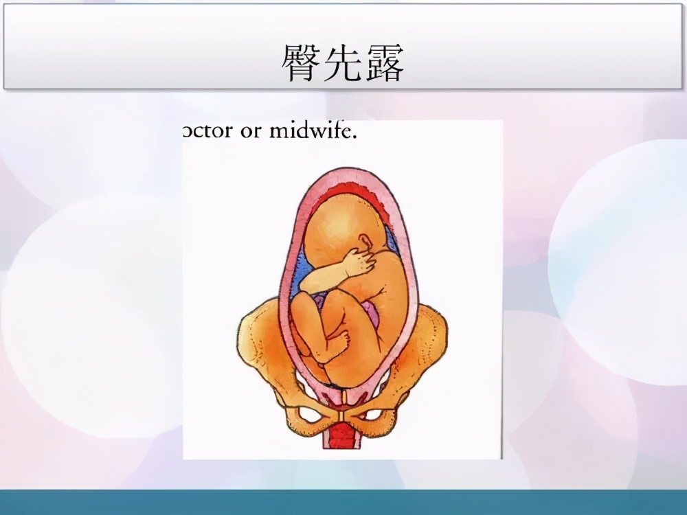 臀先露纠正胎位的时间及方法,臀先露形是什么意思