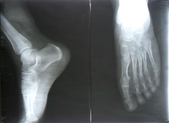 小朋友如何长高又是大长腿,儿童练长腿长高的技巧