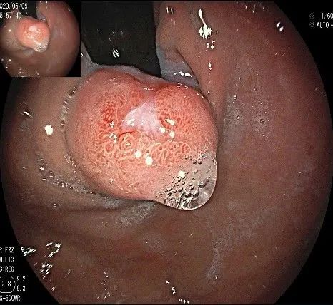 贲门处见隆起性病变,贲门高级别瘤变esd术后不能吃什么