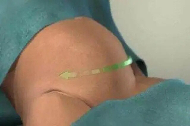 剖宫产真的比顺产好吗,剖宫产全过程解析