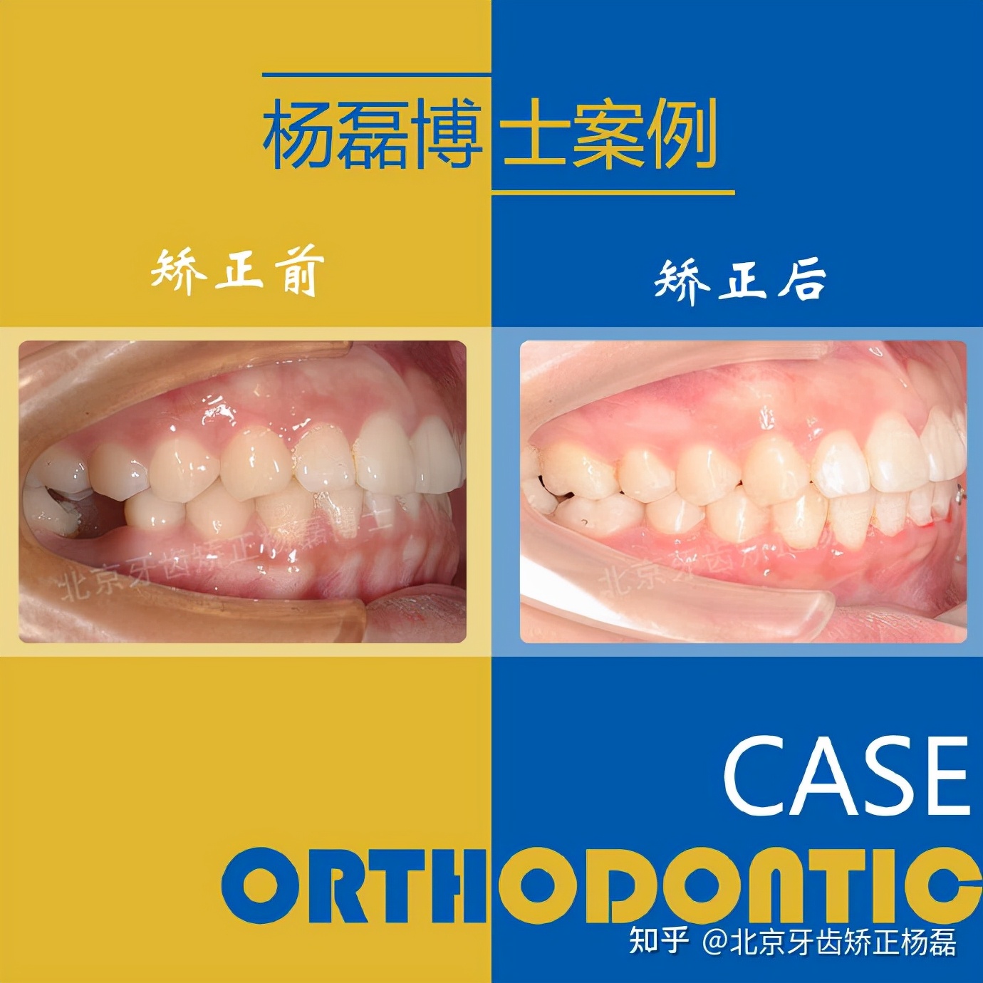 整牙半隐形牙套,缺牙可以用隐形牙套矫正的全过程