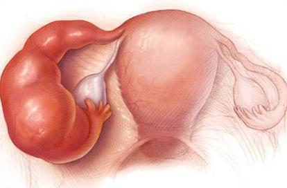 子宫腺肌病怎么治疗粘连,胎盘粘连会造成子宫腺肌症