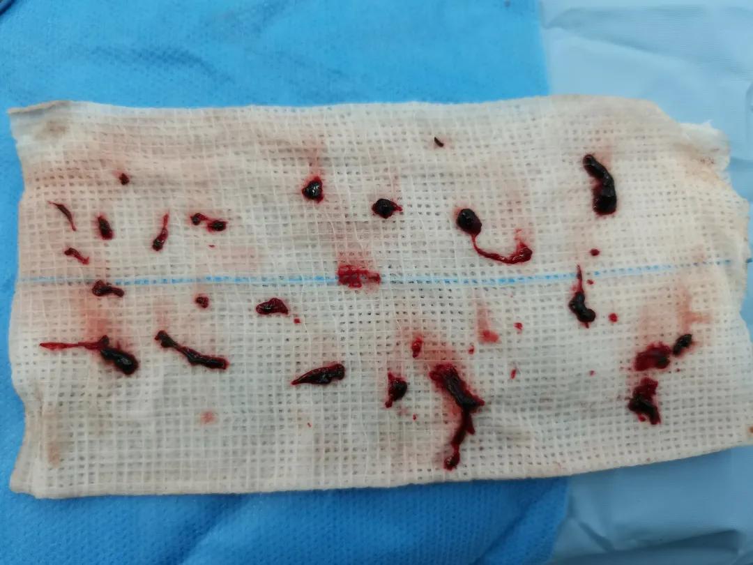 血透内瘘球囊扩张术痛吗,血透导管堵塞如何溶栓