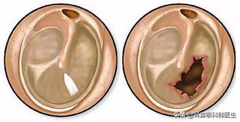 鼓膜穿孔注意事项及禁忌,鼓膜穿孔会对听力有什么影响