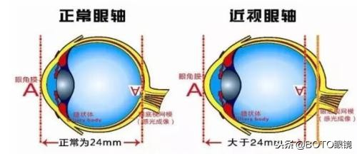 高度近视配眼镜注意事项,高度近视游乐场注意事项