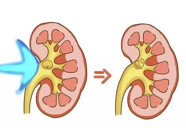 腰酸背痛会肾结石吗,腰酸是不是肾结石怎样治疗